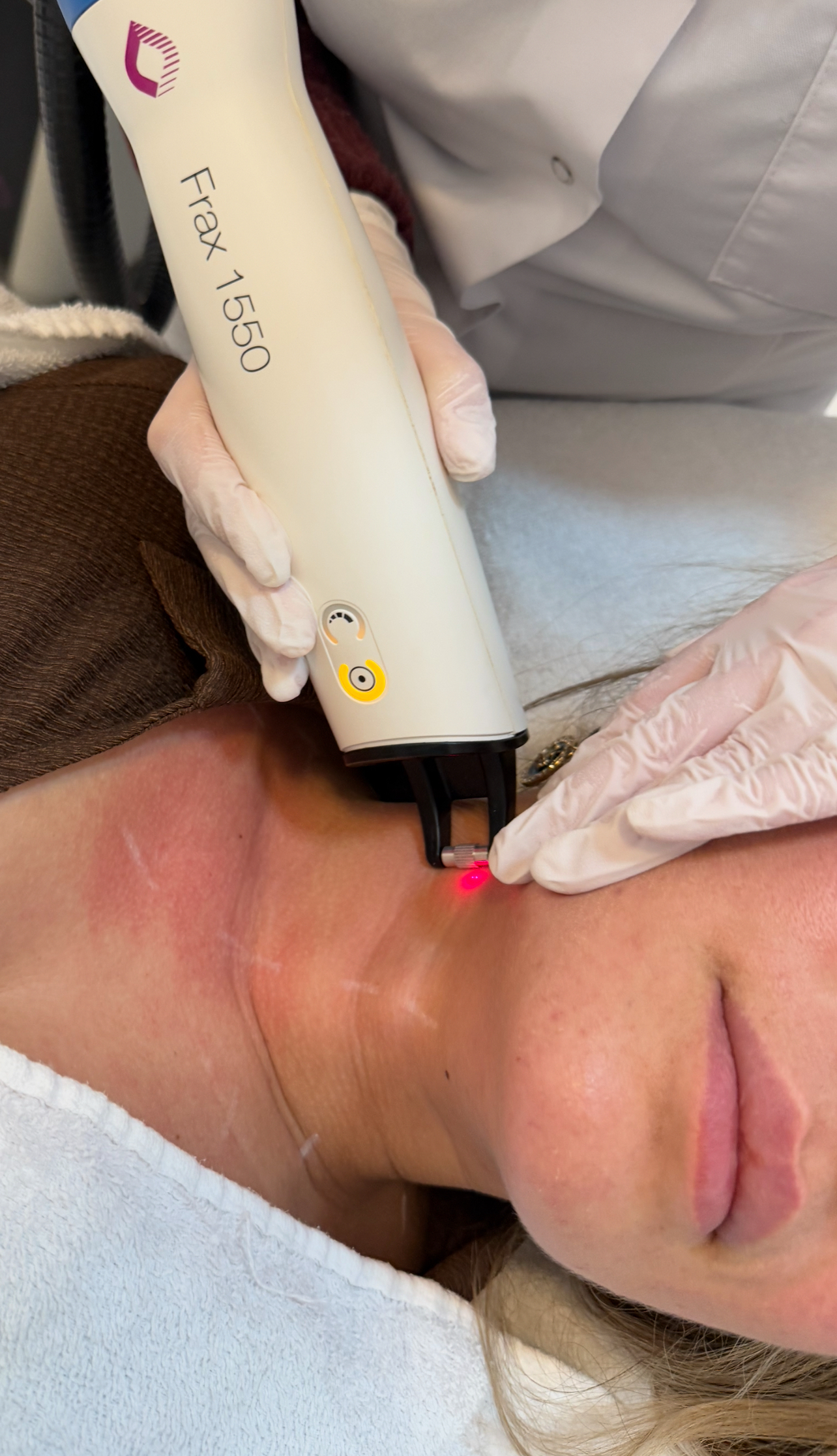 Fractional Laserbehandeling Laserkliniek in Rotterdam