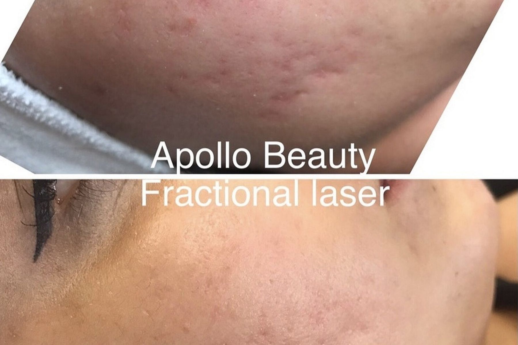 Voor En Na Foto Fractional Laserbehandeling Littekens 2