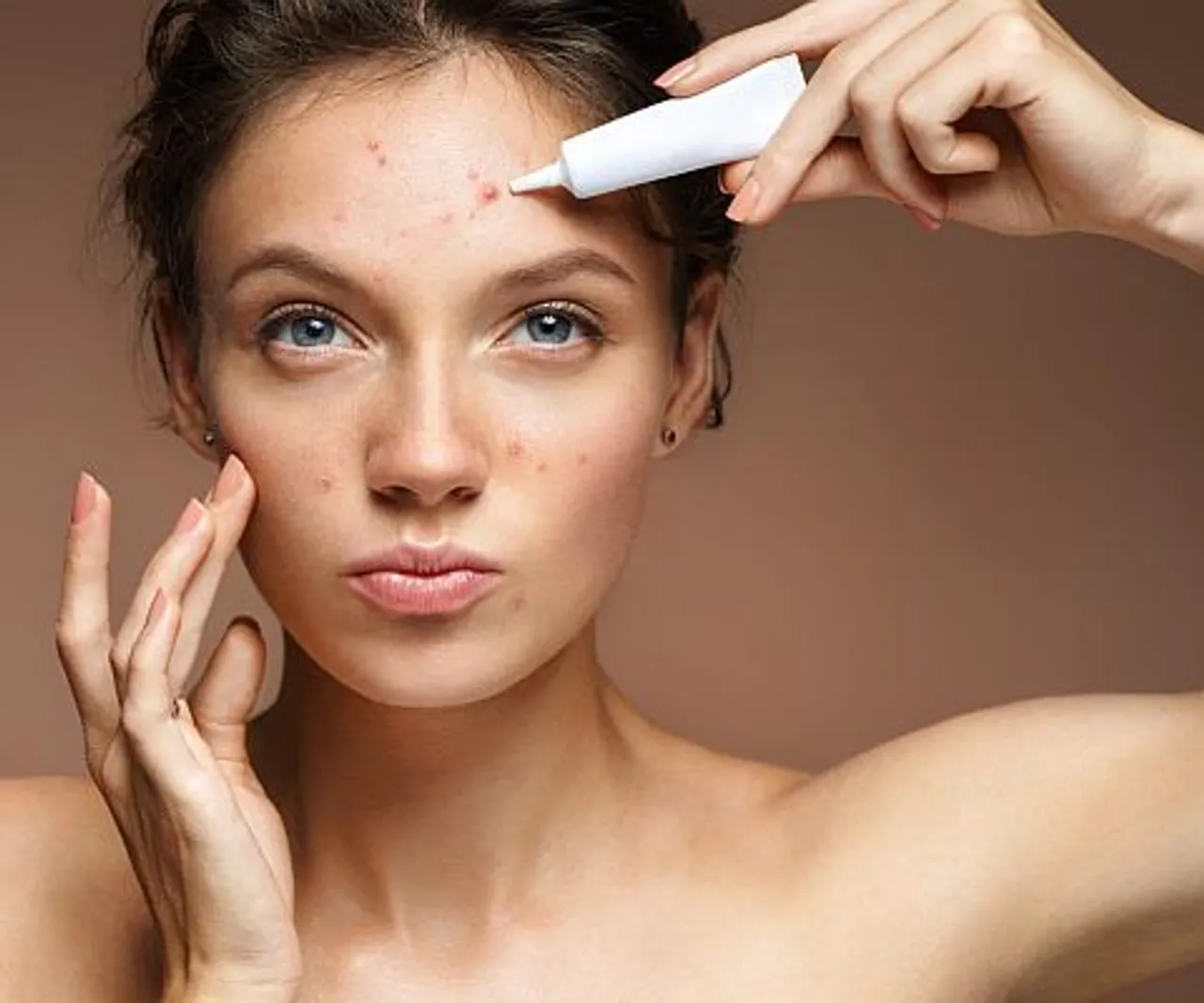 Vrouw behandelt acne op haar voorhoofd – focus op huidproblemen en gerichte huidverzorging bij Apollo Beauty.