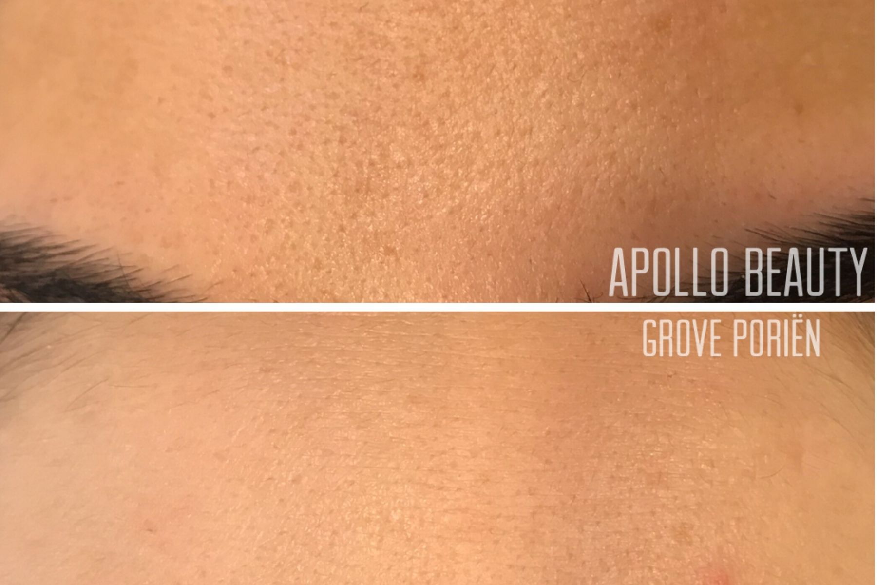 Voor En Na Foto Fractional Laserbehandeling Grove Poriën 2
