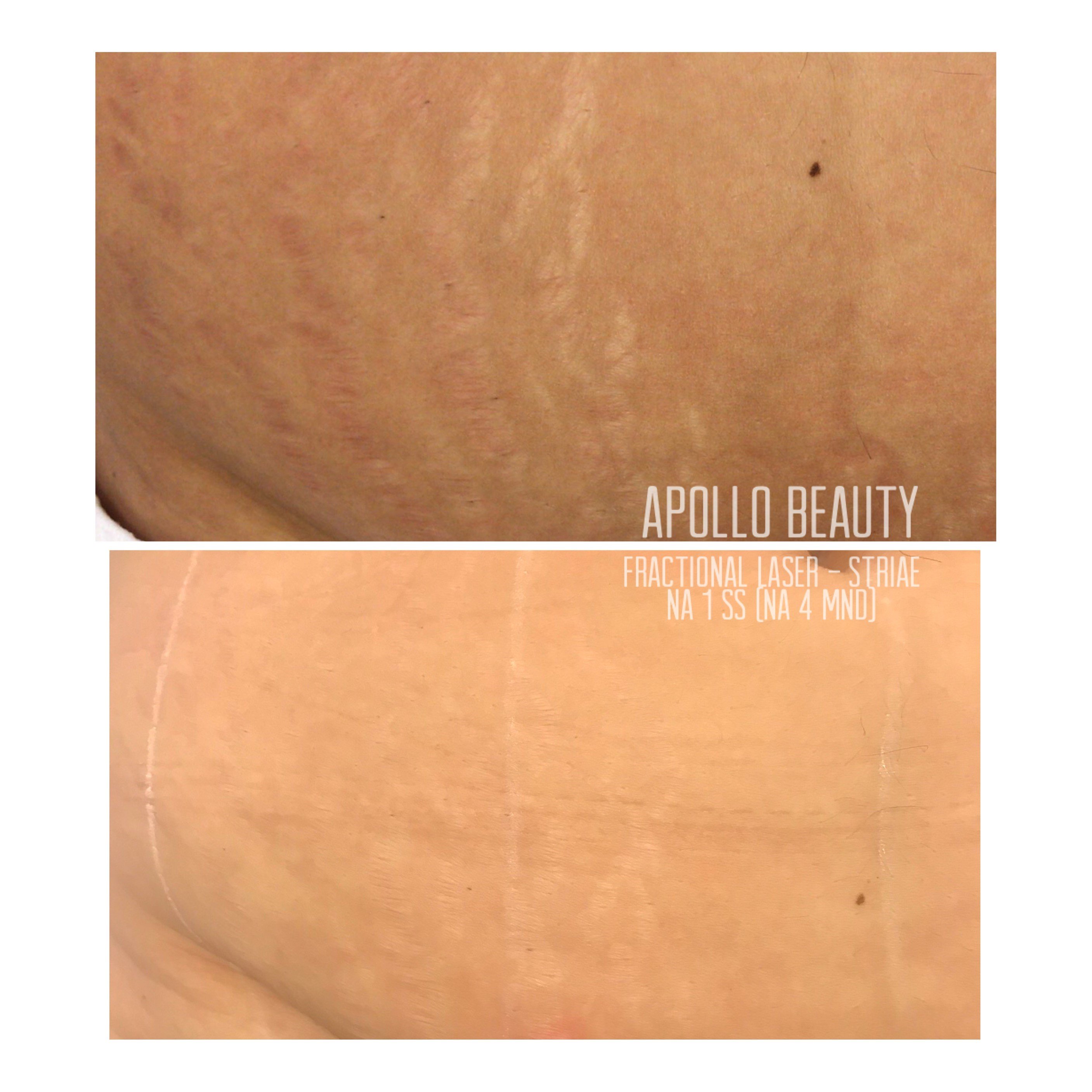 Fractional LASER Before After Striae