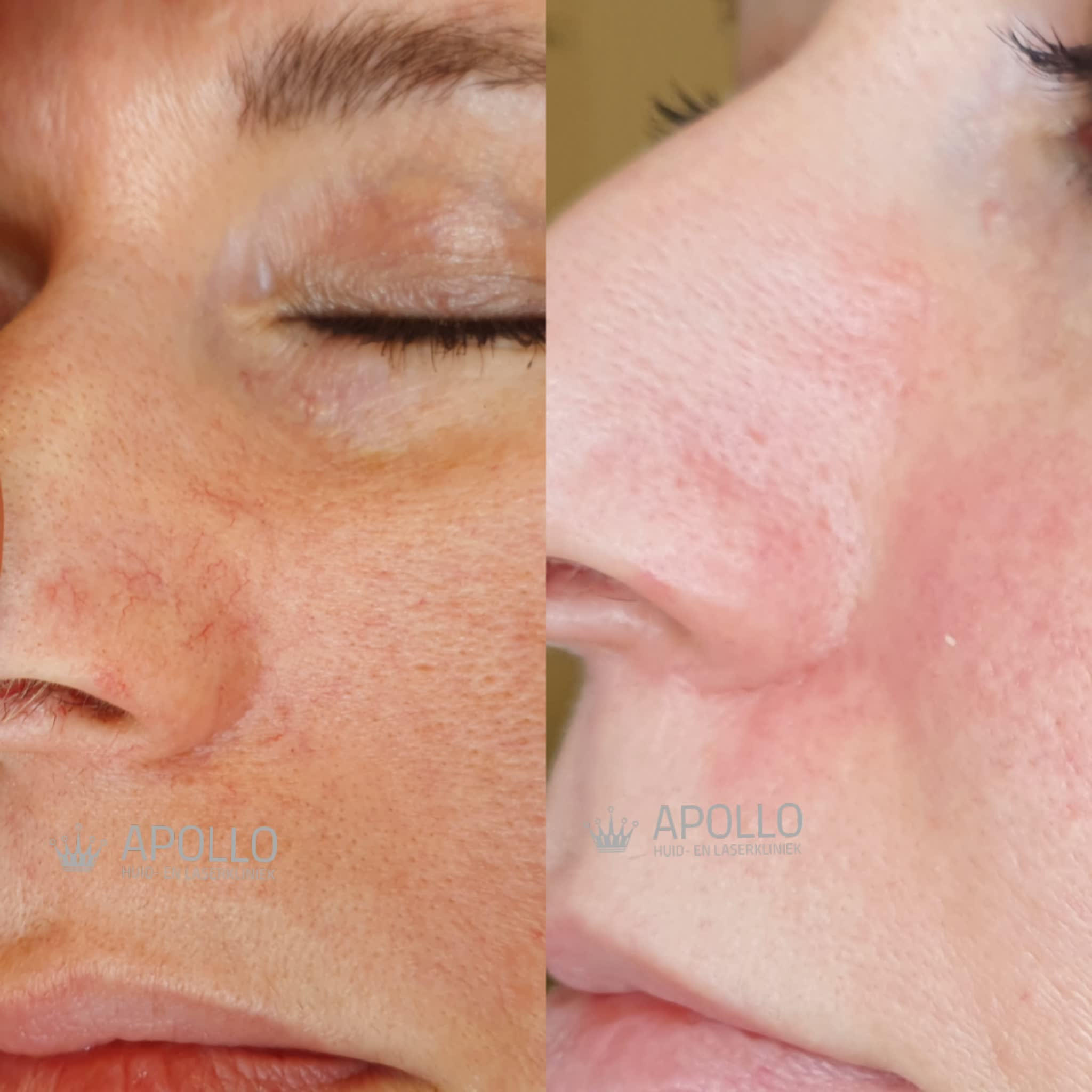 Vasculaire Behandeling 02