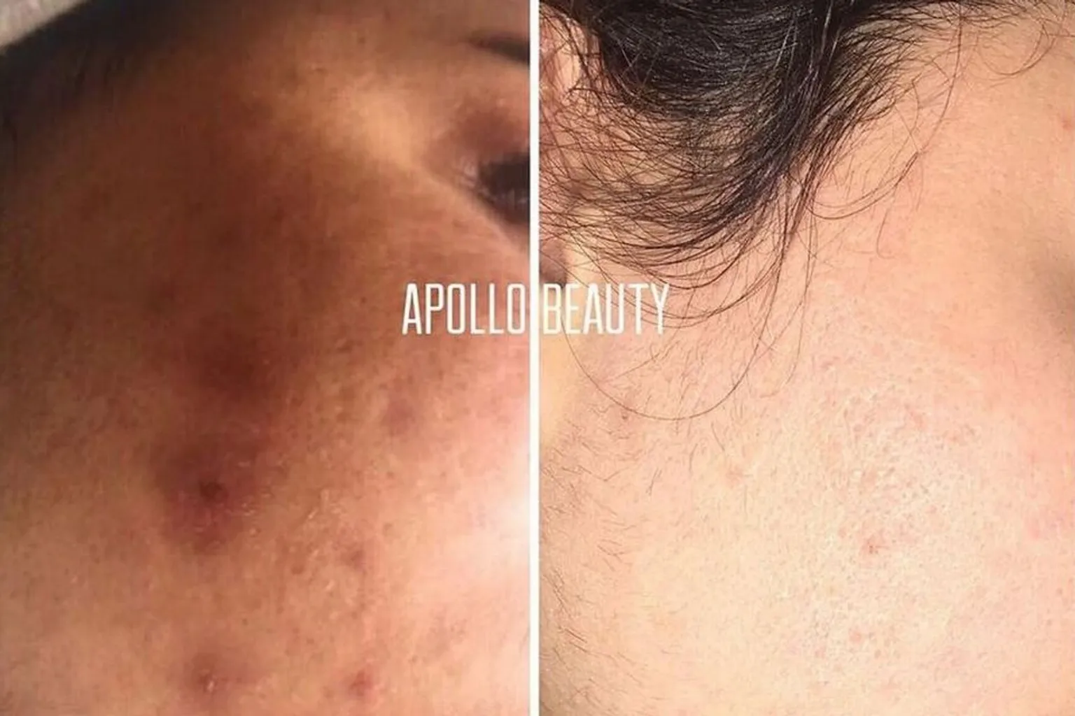 Huidverbetering na fractional laserbehandeling met vermindering van rimpels en littekens.