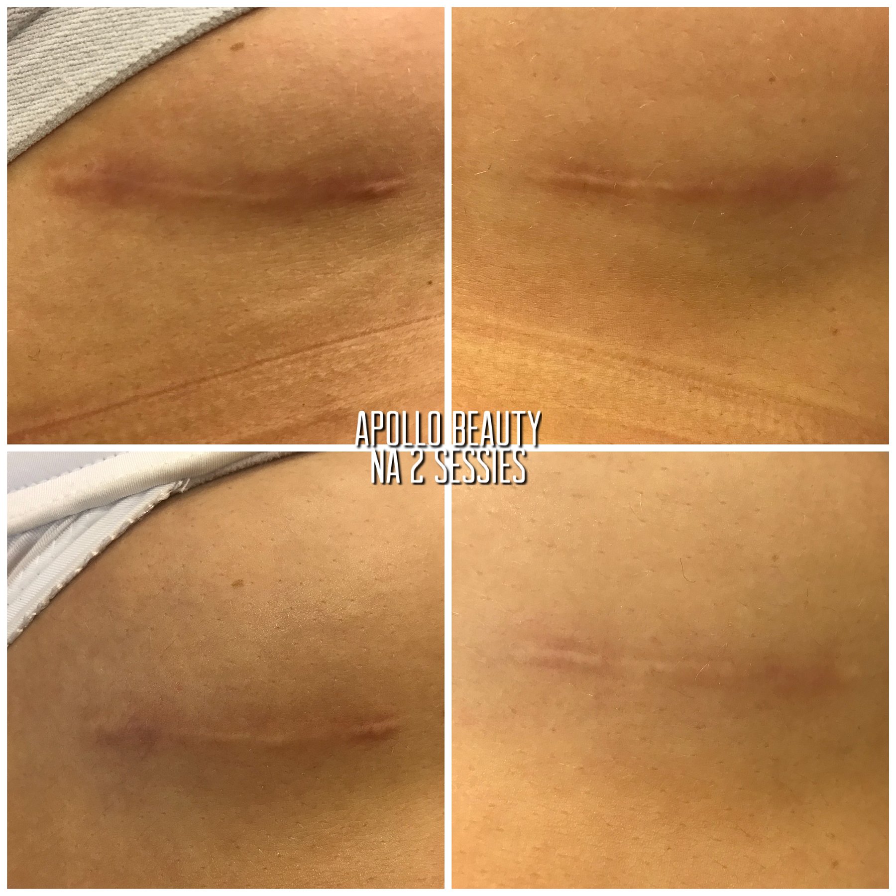 Fractional LASER Littekens Borstvergroting 2 Sessies