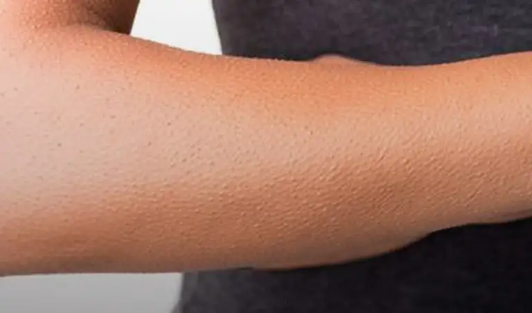 Keratosis Pilaris