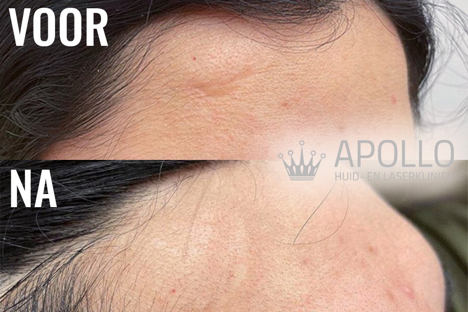 Voor Na Foto Fractional LASER 1 Behandeling