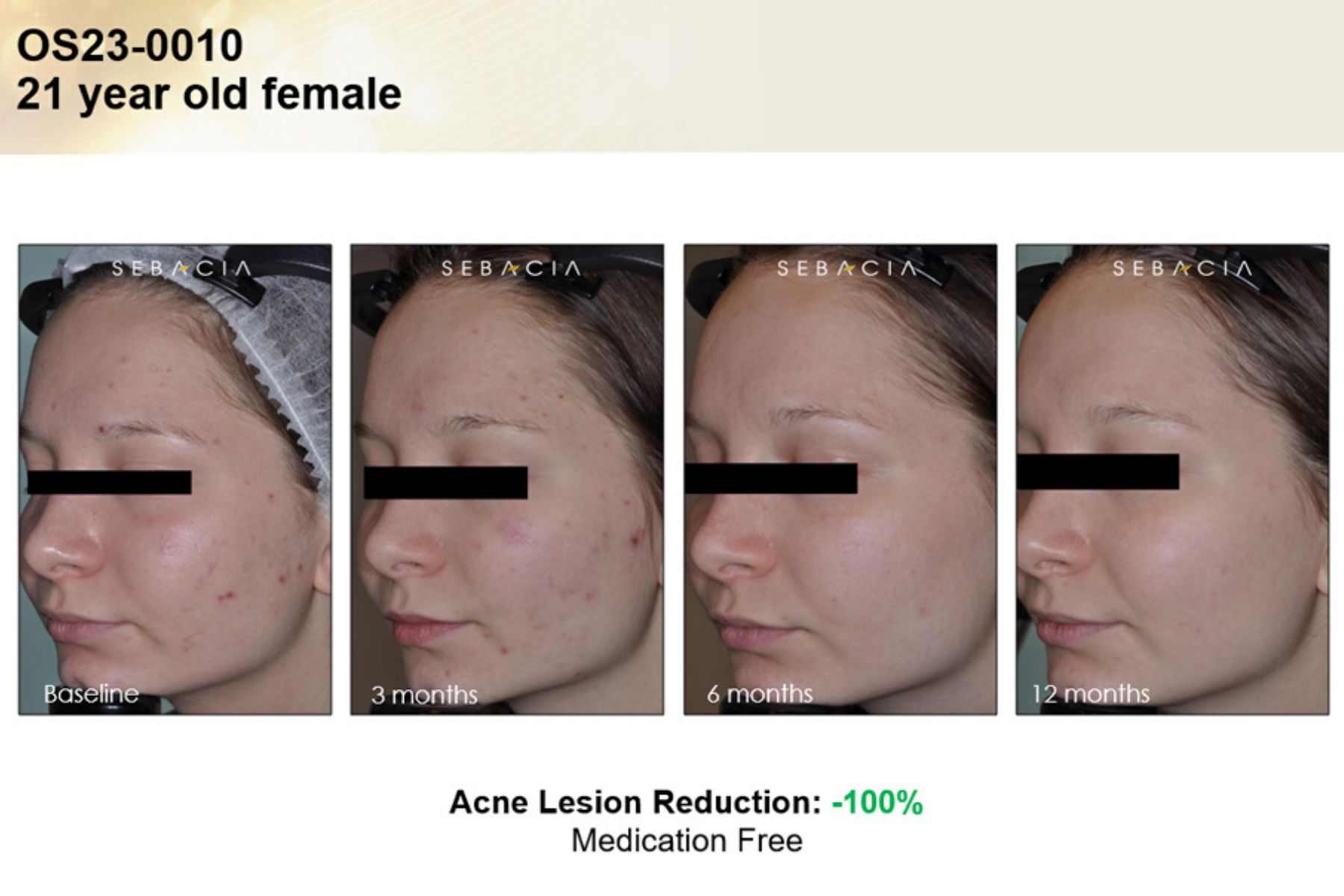 Voor En Na Foto Sebacia Acne 3