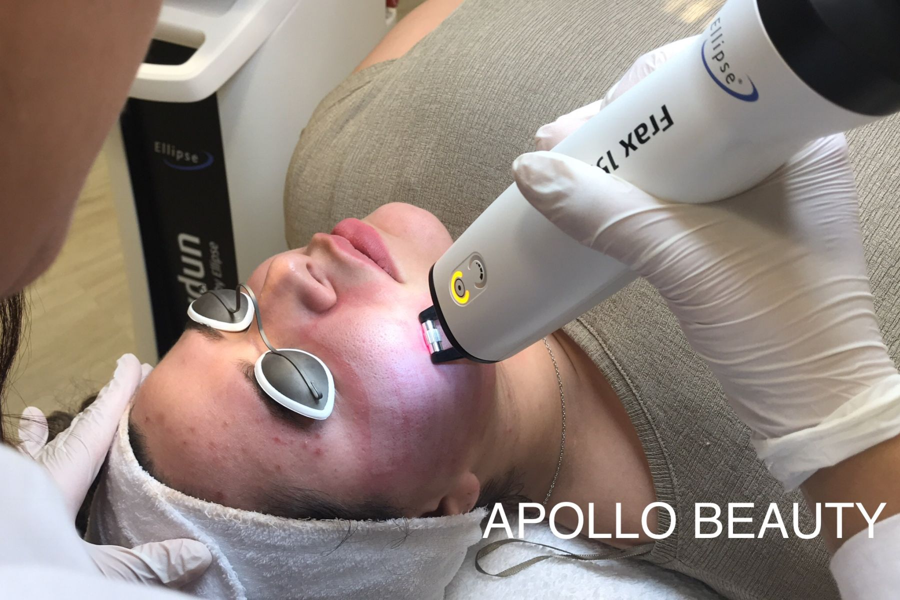 Ontdek de kracht van de Fractional laser voor een gladdere, egale huid bij Apollo Beauty.