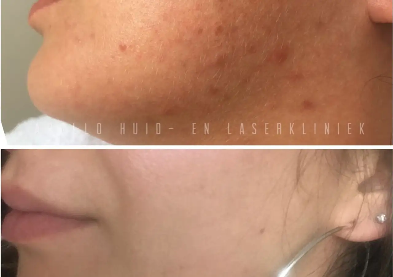 Voor en na foto van een acne behandeling bij onze Beautysalon in Rotterdam