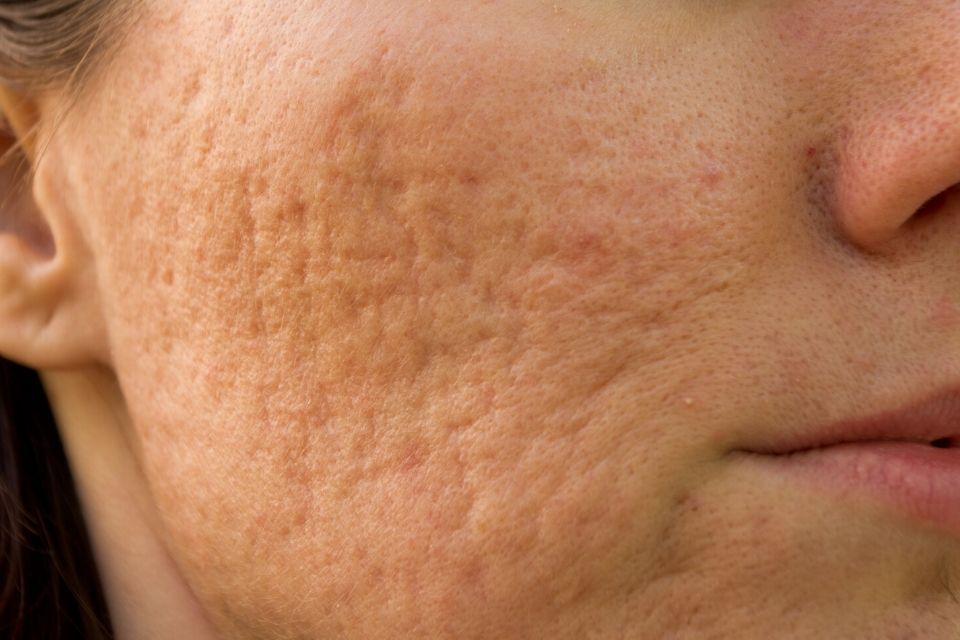Close-up van huid met acne-littekens en grove poriën op de wang.