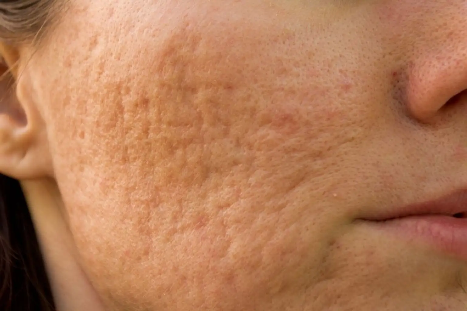 Close-up van huid met acne-littekens en grove poriën op de wang.