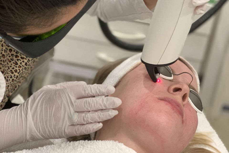 Fractional LASER Behandeling 1