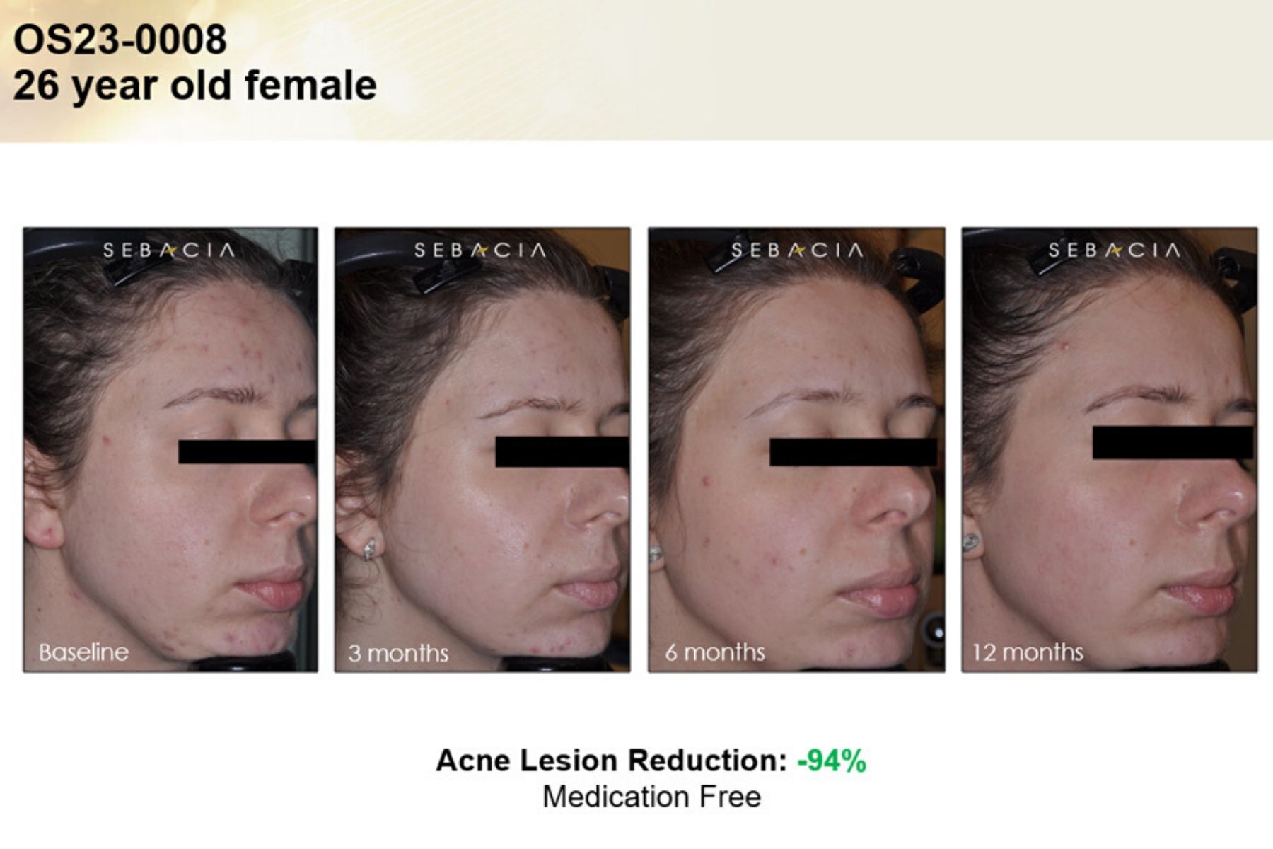 Voor En Na Foto Sebacia Acne 4