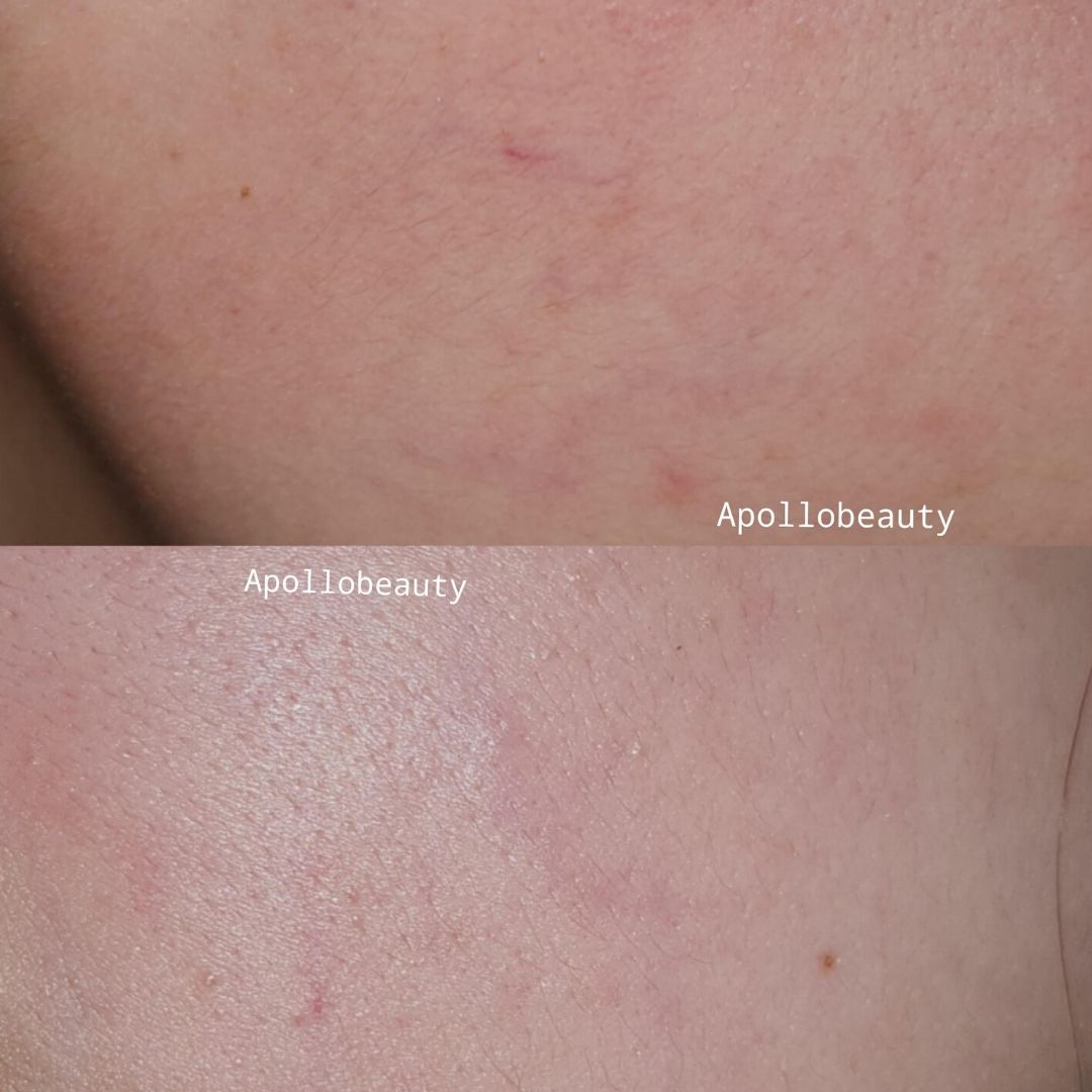 Vasculaire Behandeling 05