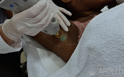 Prijzen laser ontharen