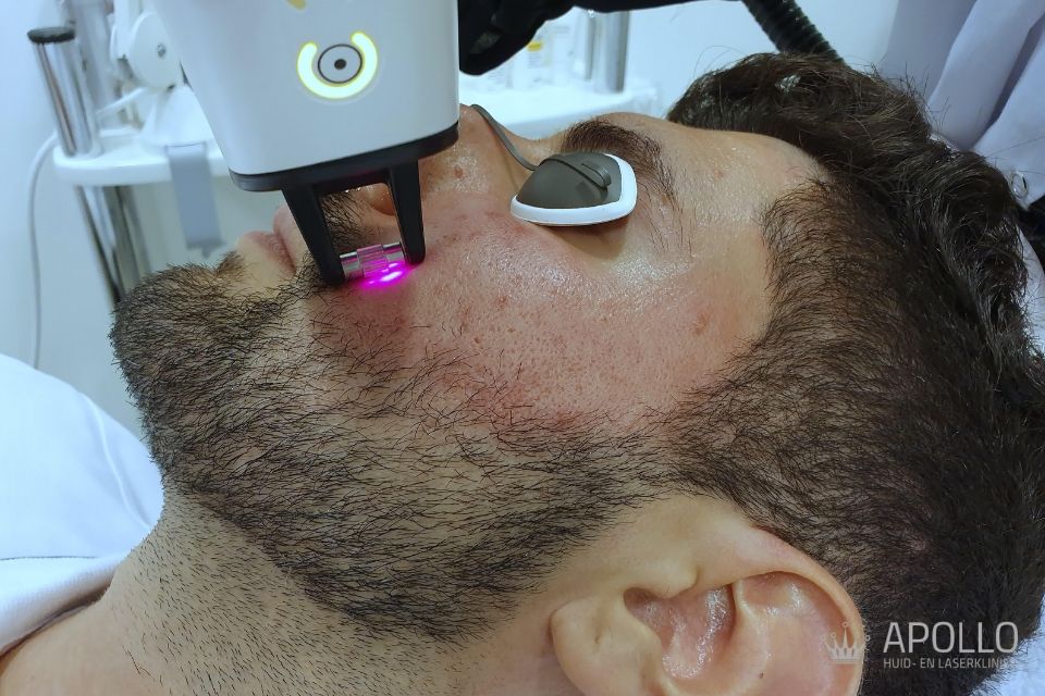 Fractional Laserbehandeling