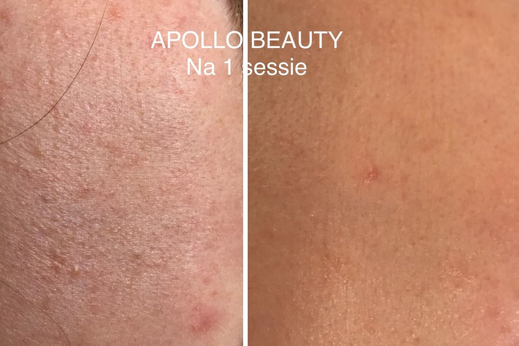 Voor En Na Foto Fractional Laserbehandeling Grove Poriën 1