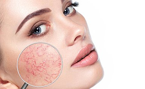 Prijzen couperose behandeling