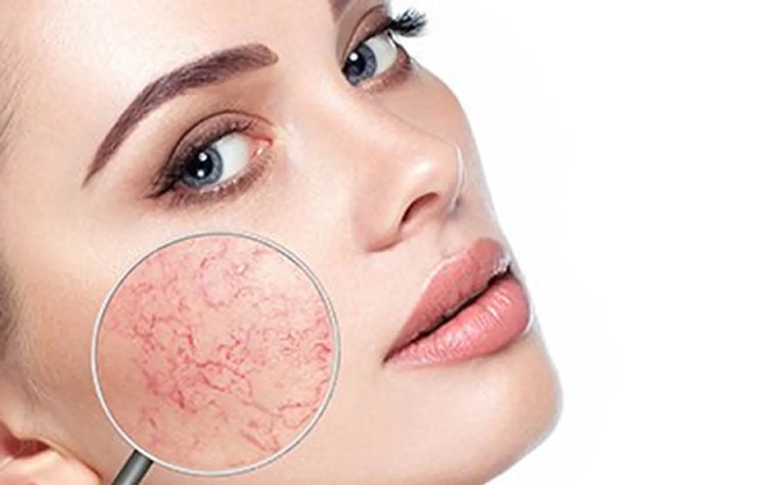 Prijzen couperose behandeling