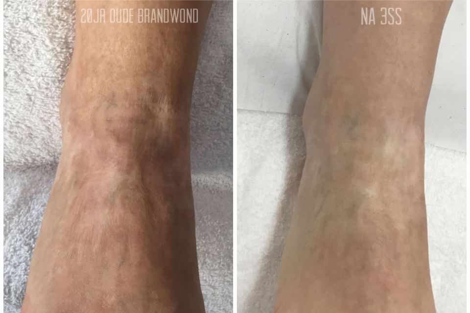 Fractional LASER 01