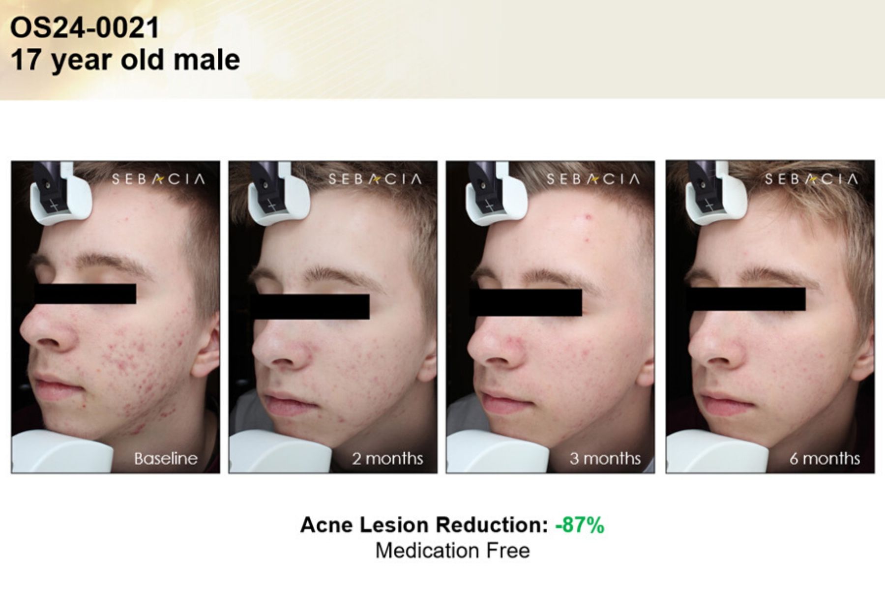 Voor En Na Foto Sebacia Acne 10