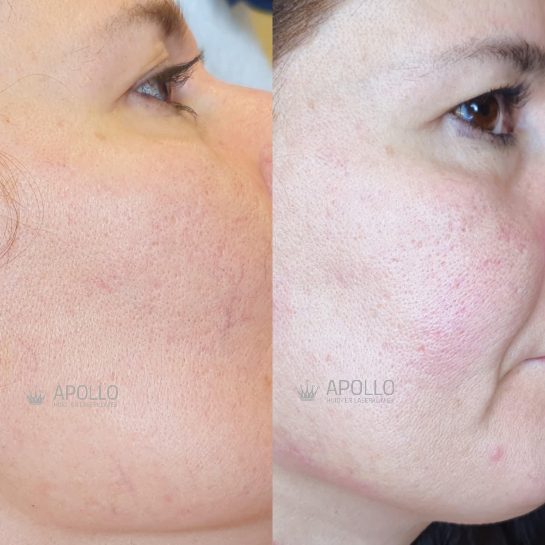 Vasculaire Behandeling 03