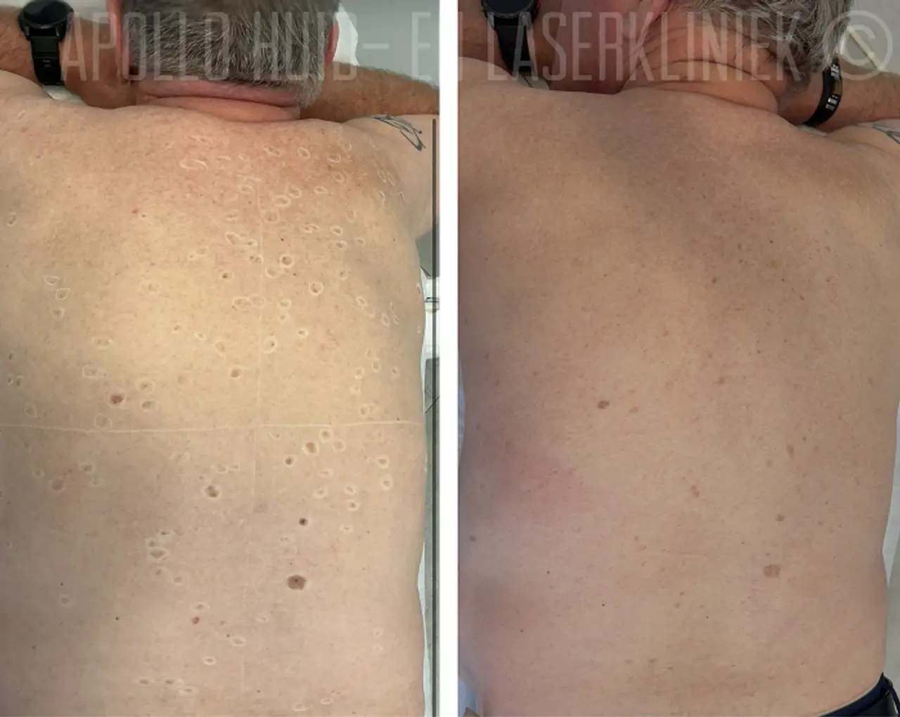 Pigmentlaser behandeling voor en na foto van 1 behandeling