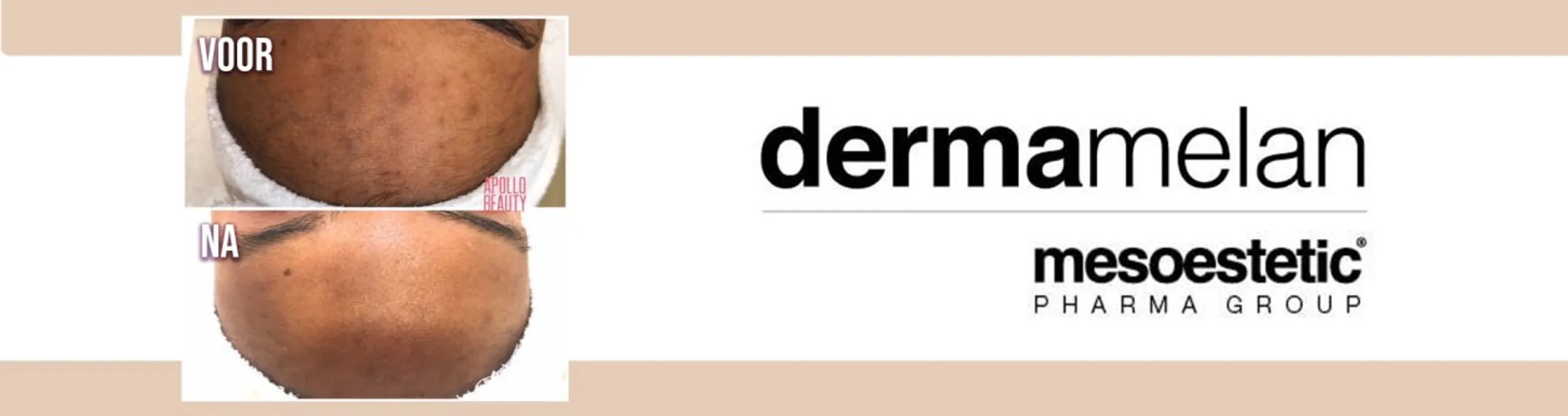 Voor en na resultaat van Dermamelan behandeling bij pigmentvlekken