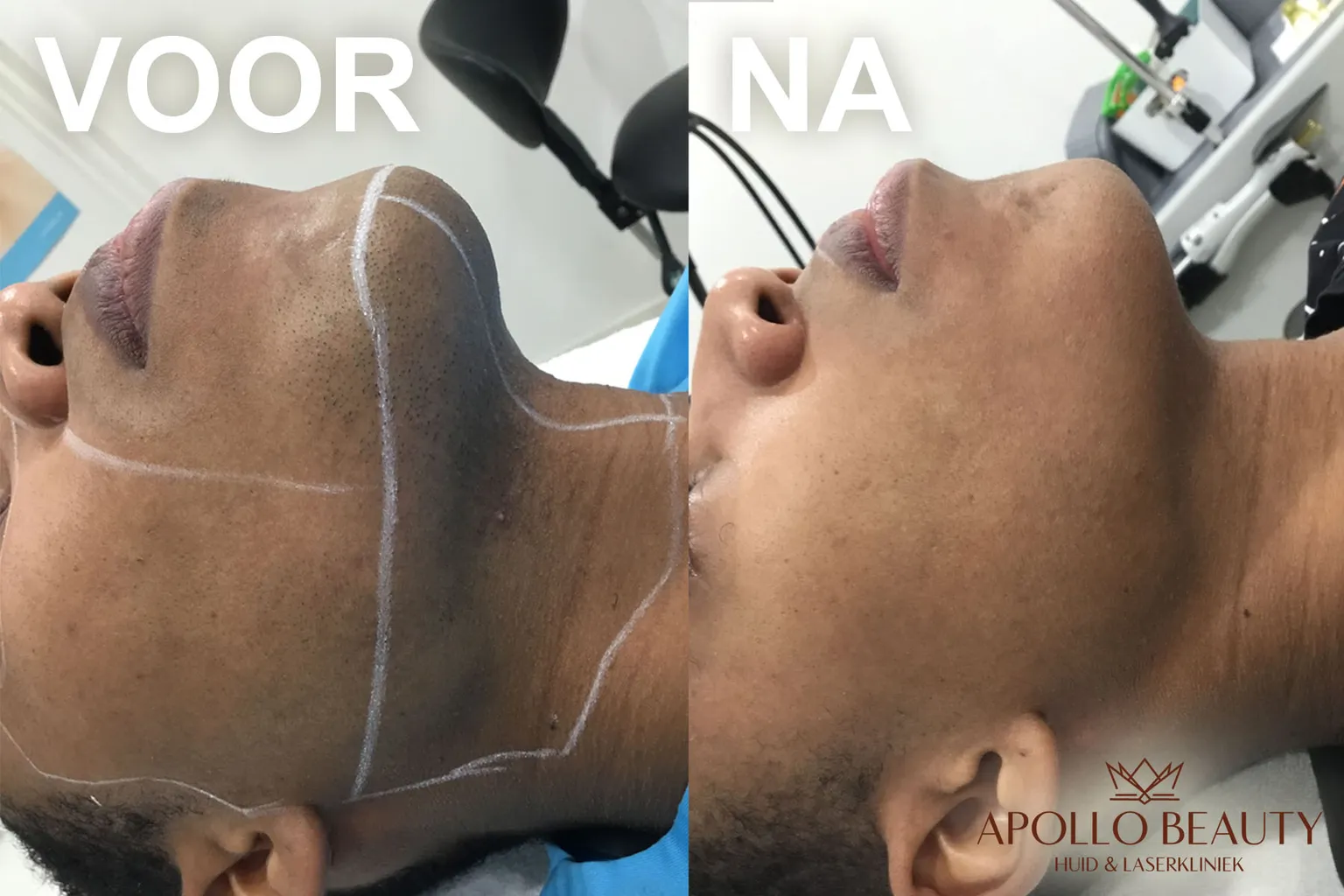 Voor- en na foto van laserontharing met gladde, haarvrije huid na meerdere sessies.