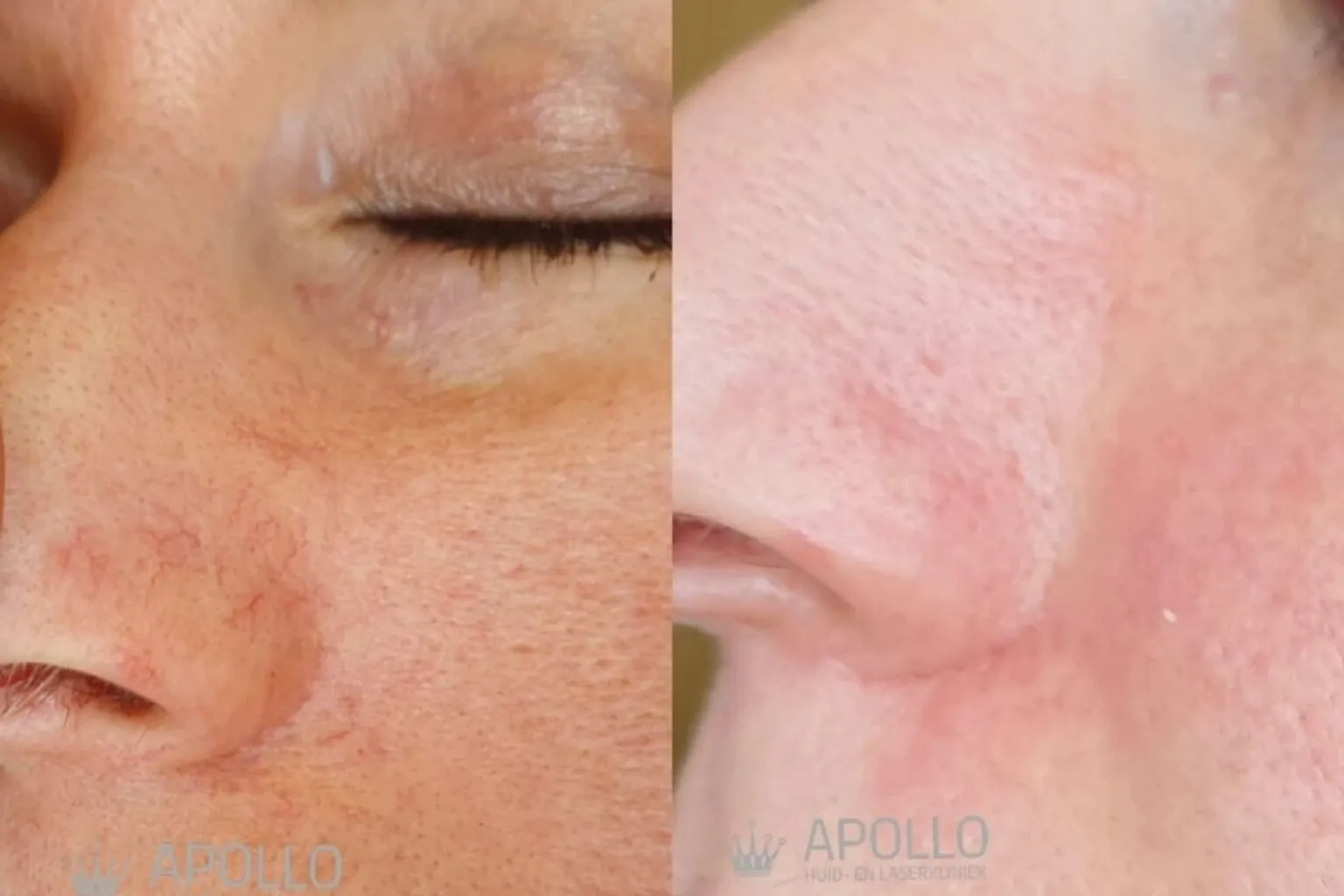 Voor- en na resultaat van vasculaire laserbehandeling met zichtbaar minder roodheid en adertjes.