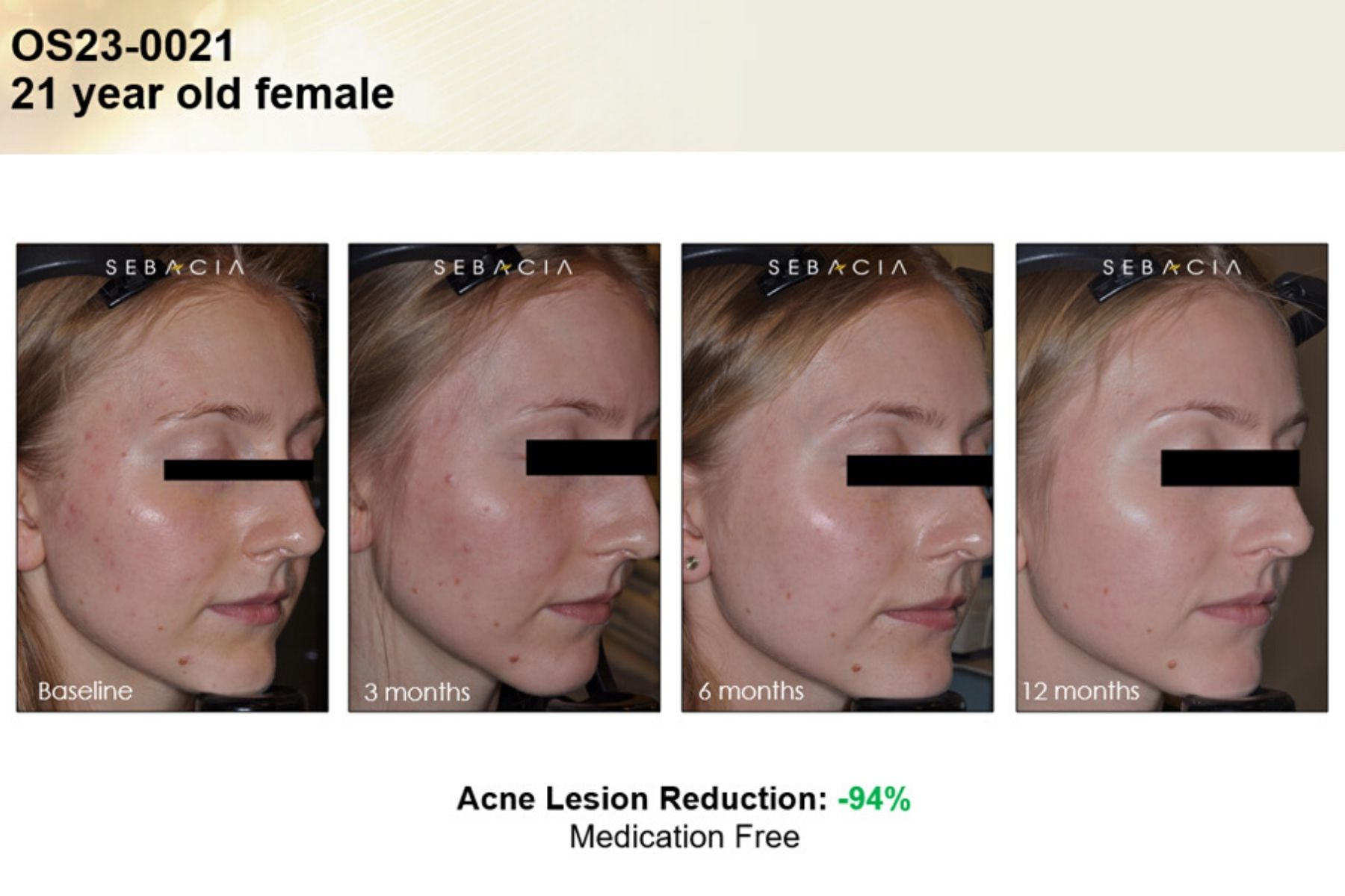 Voor En Na Foto Sebacia Acne 5