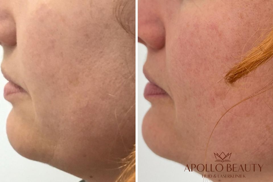 Resultaat Na 1 Hifu Behandeling Apollo Beauty