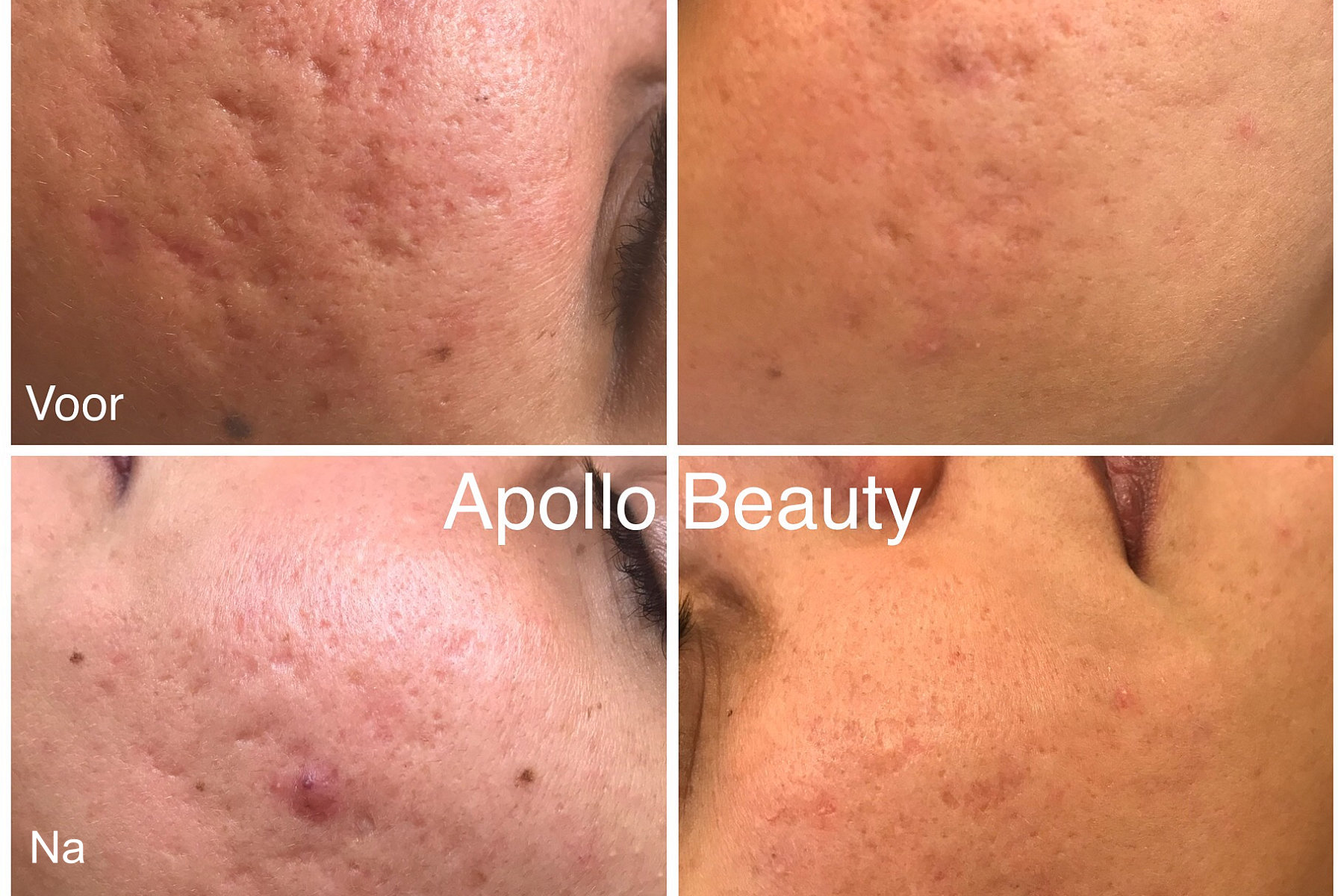 Fractional LASER Voor Na Acne 2