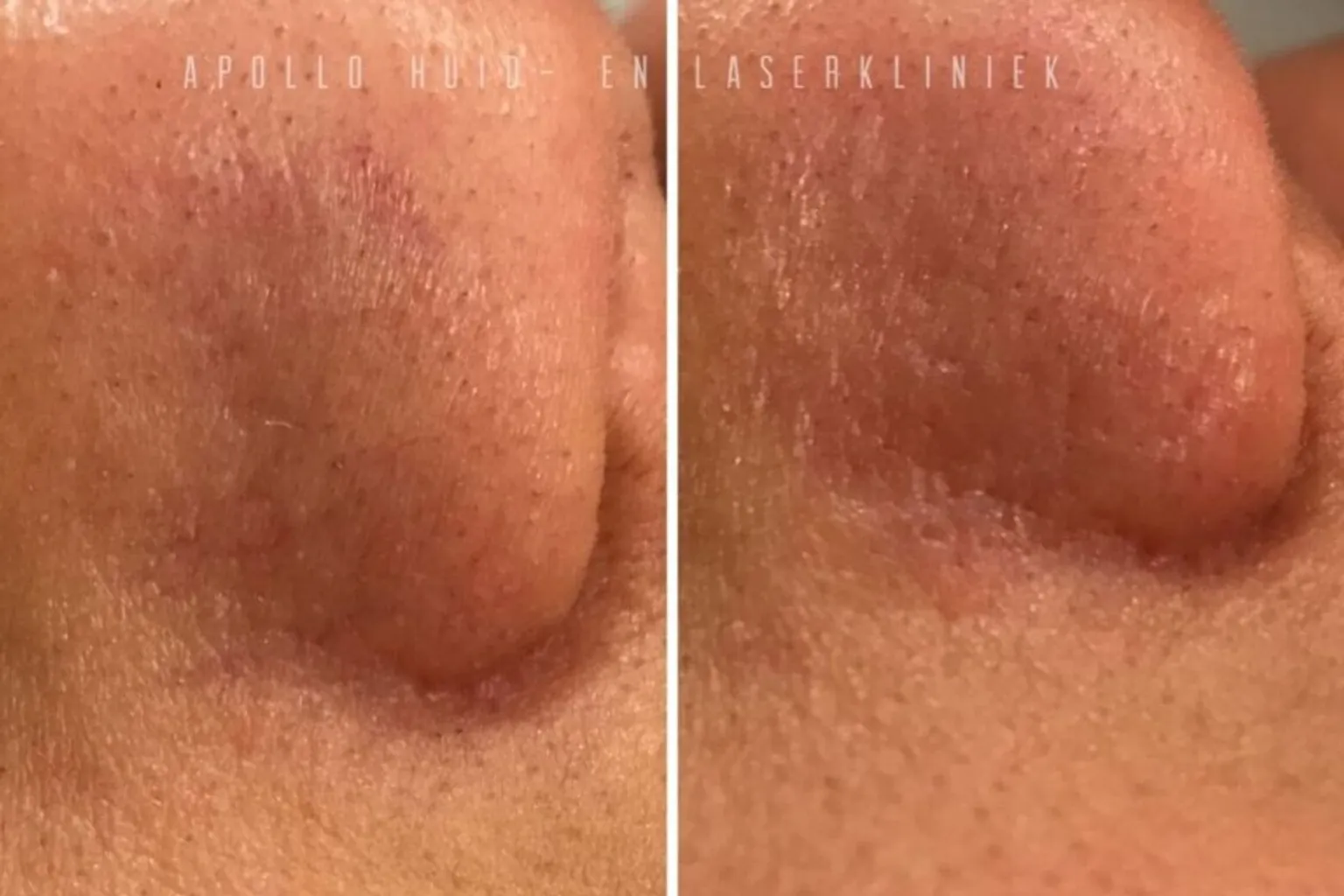 Voor- en na foto van behandeling van rode adertjes (teleangiëctasieën) met rustiger huidtint.