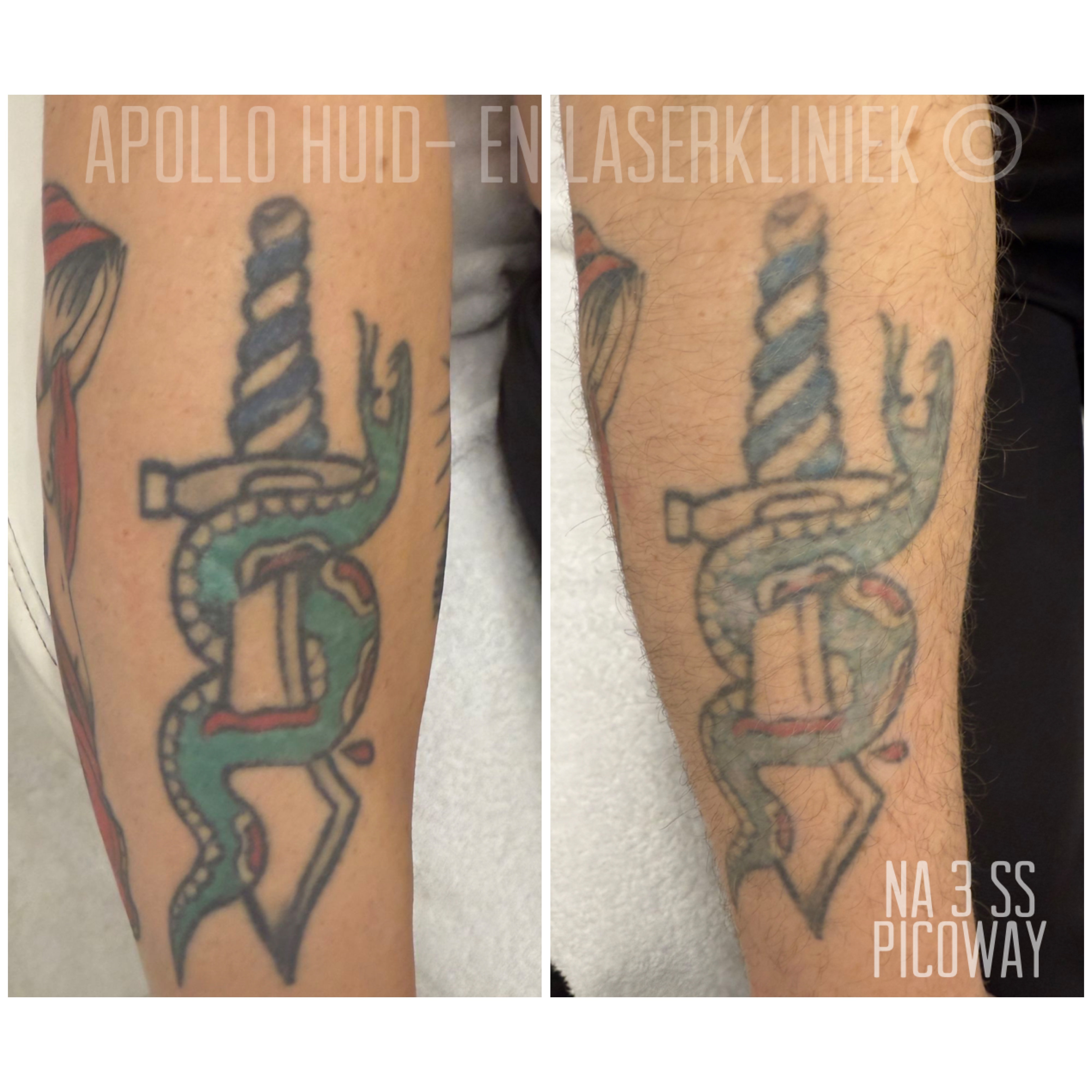 Tatoeage verwijderen ervaring van Nick bij Apollo Beauty