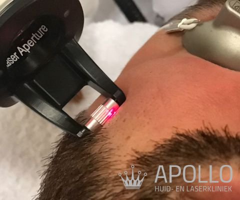Laserbehandeling tegen acne bij Apollo Beauty Huid & Laserkliniek.