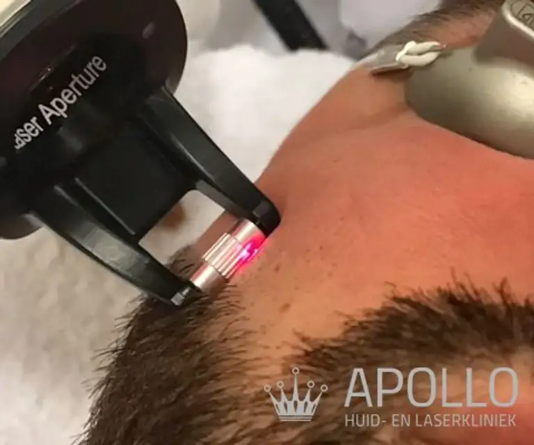 Laserbehandeling tegen acne bij Apollo Beauty Huid & Laserkliniek.