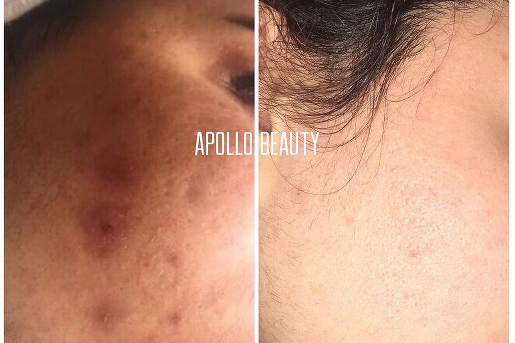 Fractional LASER Voor Na 1 Behandeling
