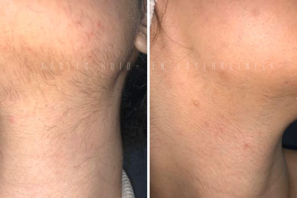 Voor en na overbeharing behandeling