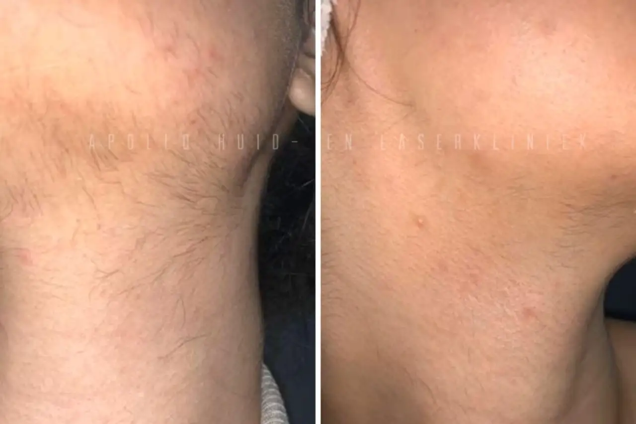 Voor en na overbeharing behandeling