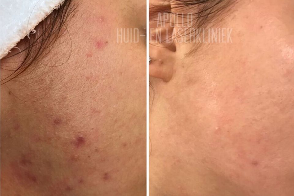 Voor- en na foto van acnebehandeling met zichtbaar gladdere, egale huid na therapie.