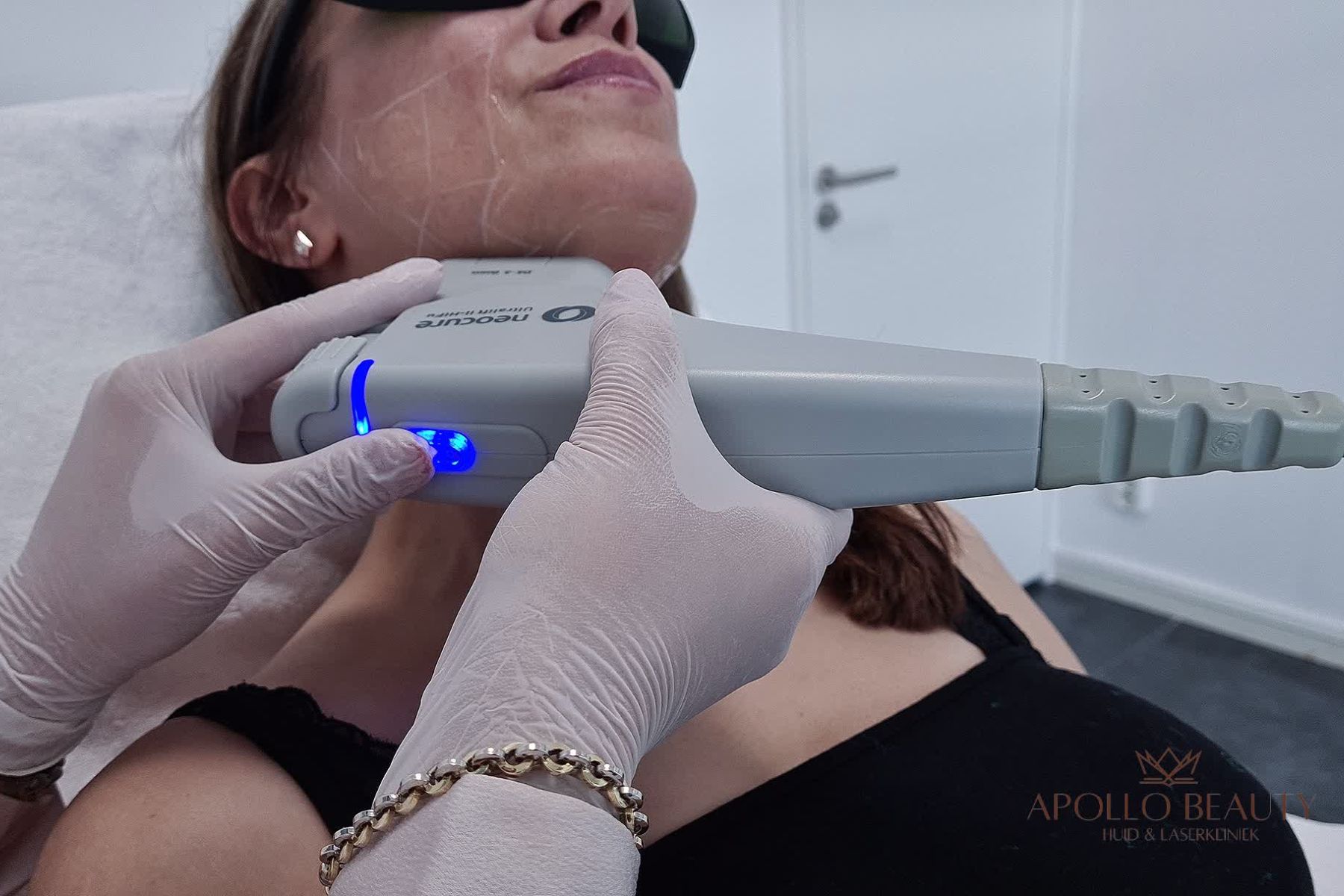 Hifu behandelingen ook in de actie 