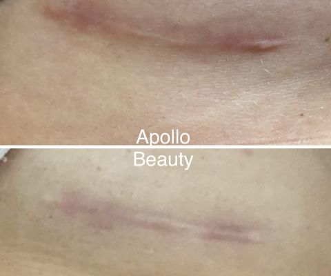 Succesvolle littekenbehandeling met fractional laser