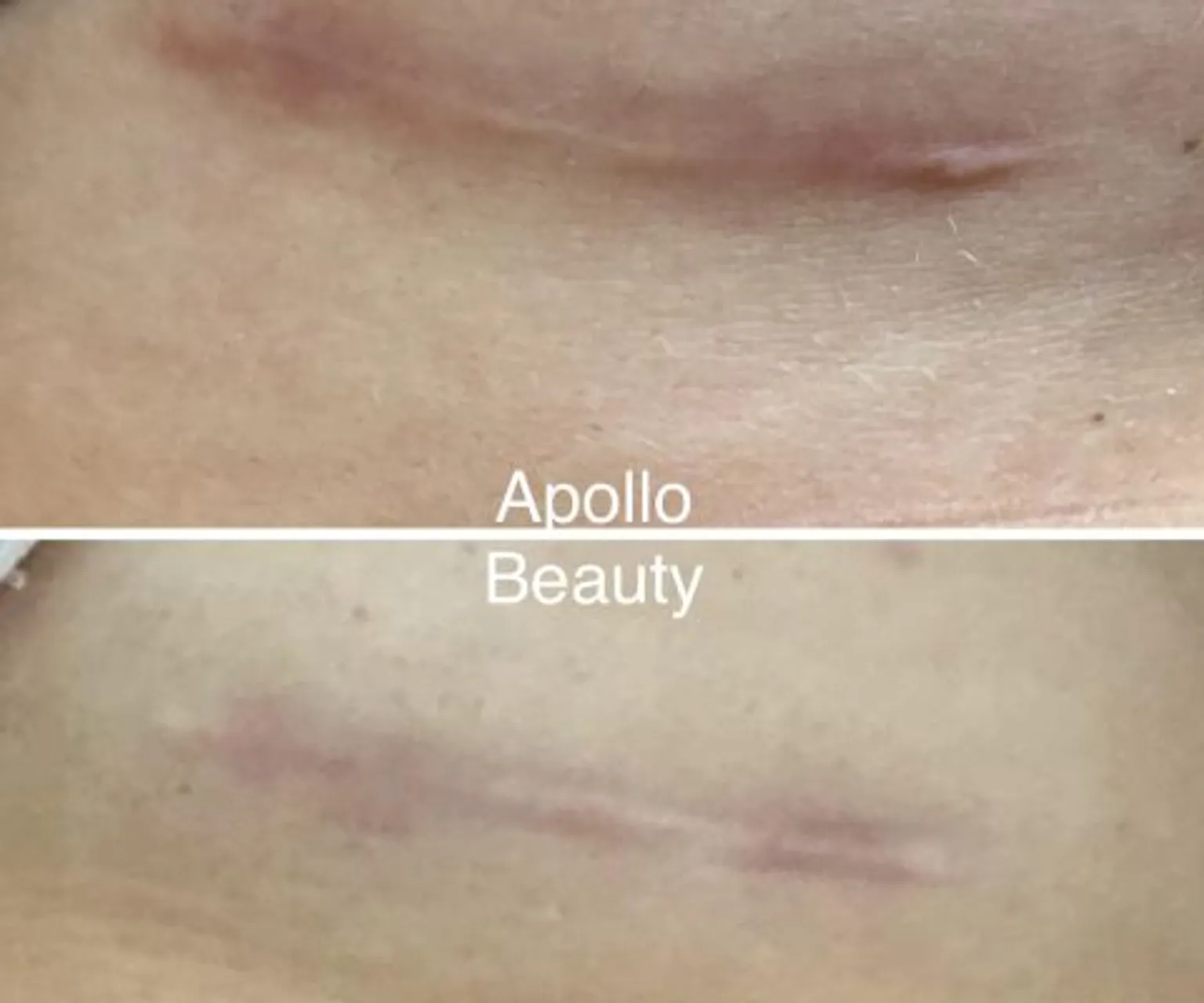 Succesvolle littekenbehandeling met fractional laser