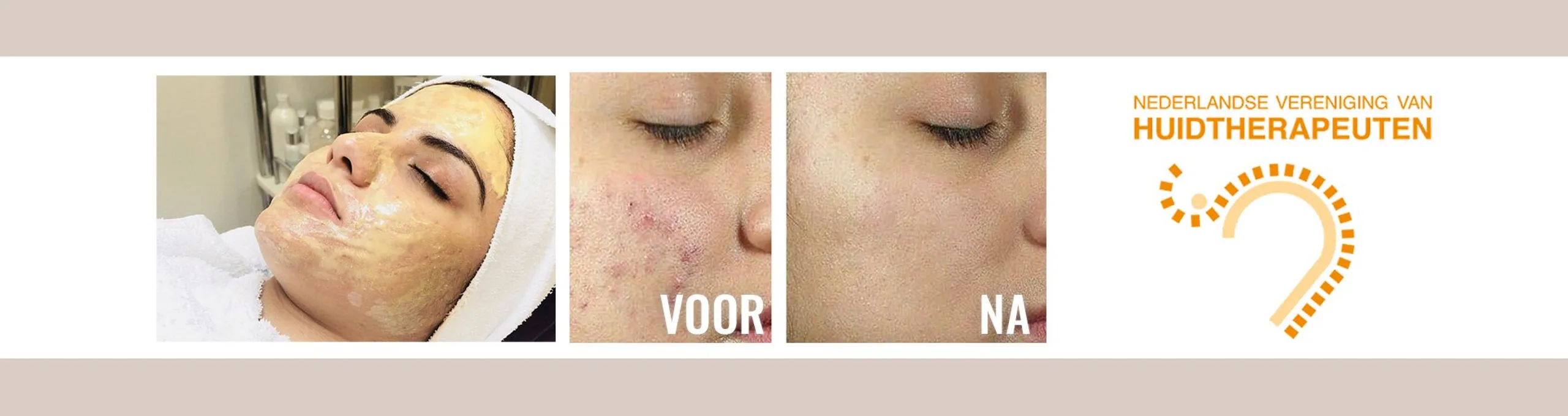 Huidtherapie Peeling voor en na foto