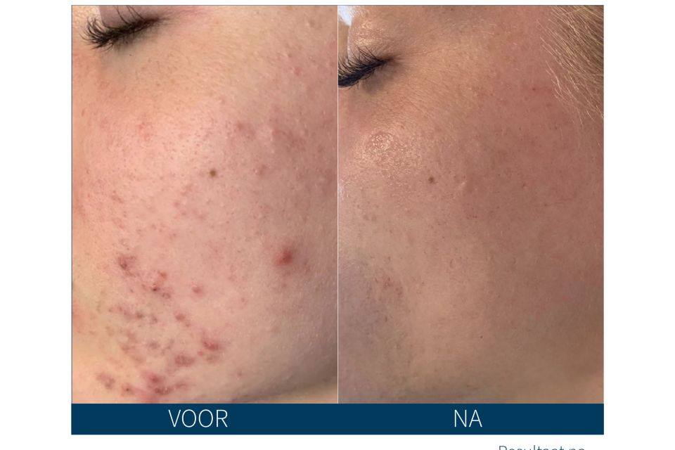 Resultaten van SkinPen microneedling met verfijnde huidstructuur en vermindering van lijntjes.