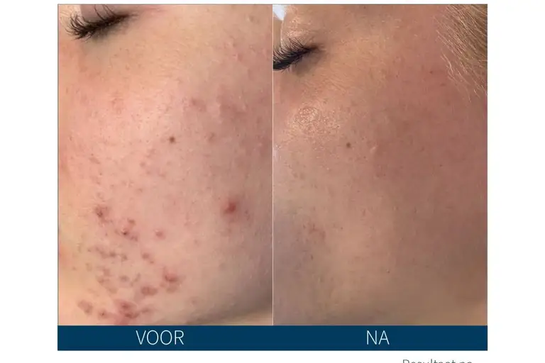 Resultaten van SkinPen microneedling met verfijnde huidstructuur en vermindering van lijntjes.