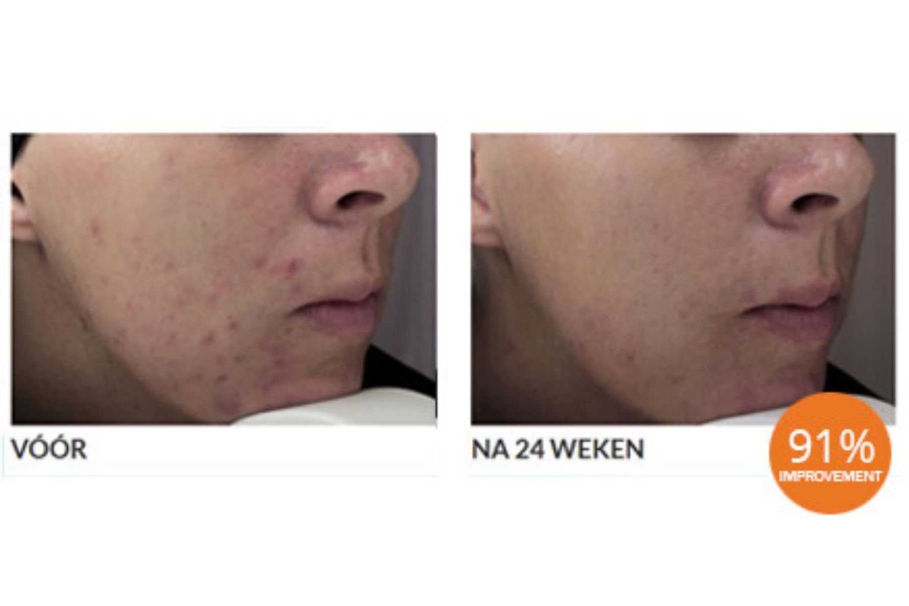 Voor En Na Foto Sebacia Acne 2