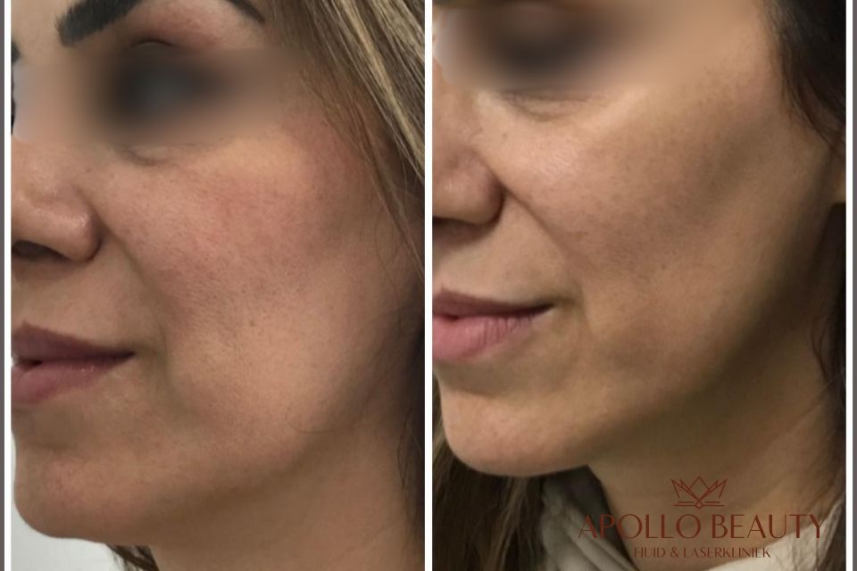 Resultaat Na 1 Hifu Behandeling Apollo Beauty 03