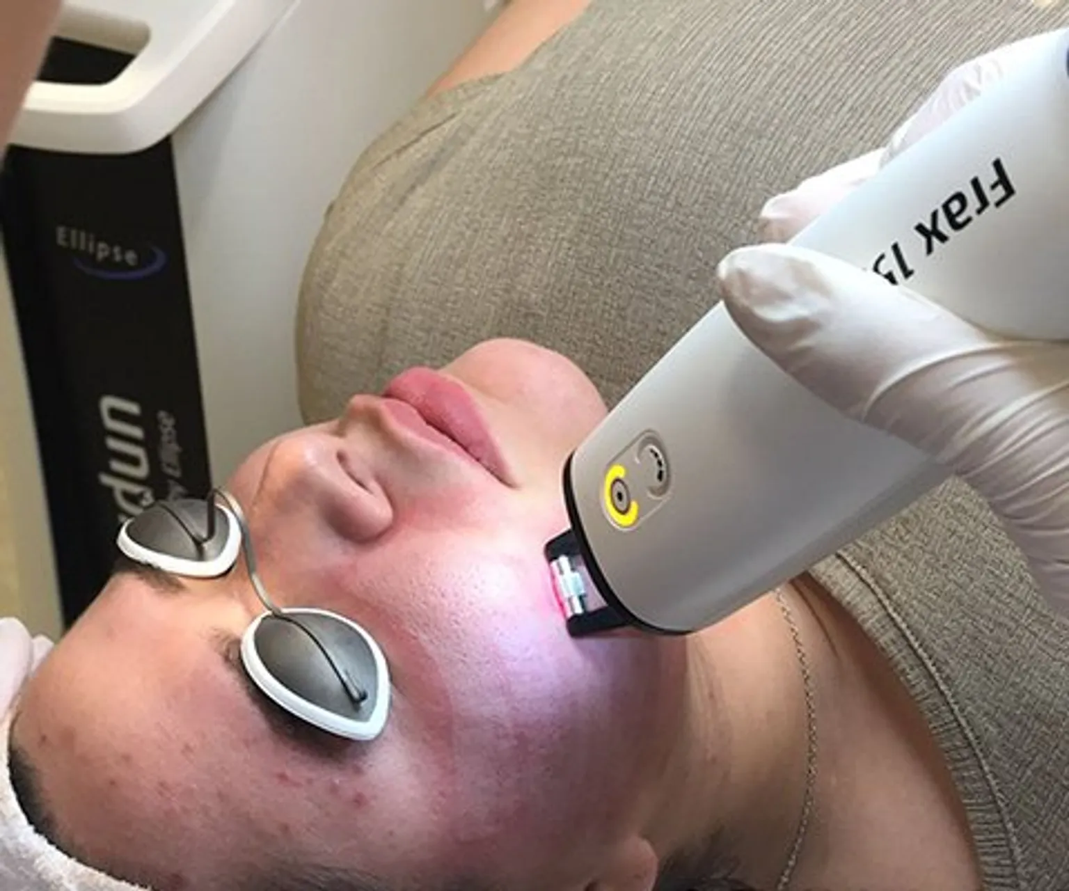 Laserbehandeling tegen acne bij Apollo Beauty Huid & Laserkliniek.